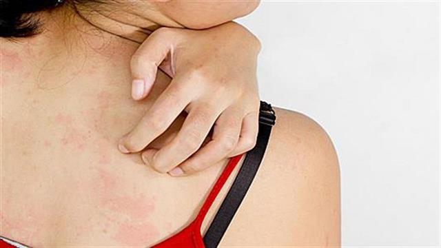 Άγχος και δερματικές παθήσεις