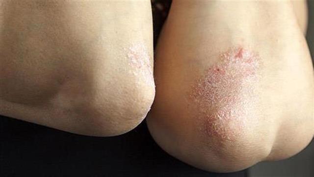 Ψωρίαση: Υπεροχή της σεκουκινουμάμπης έναντι της ουστεκινουμάμπης