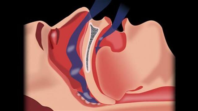 Υπνική άπνοια: Συμπτώματα και διάγνωση
