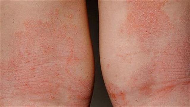 Αποτελέσματα μελετών για το dupilumab σε ασθενείς με ατοπική δερματίτιδα