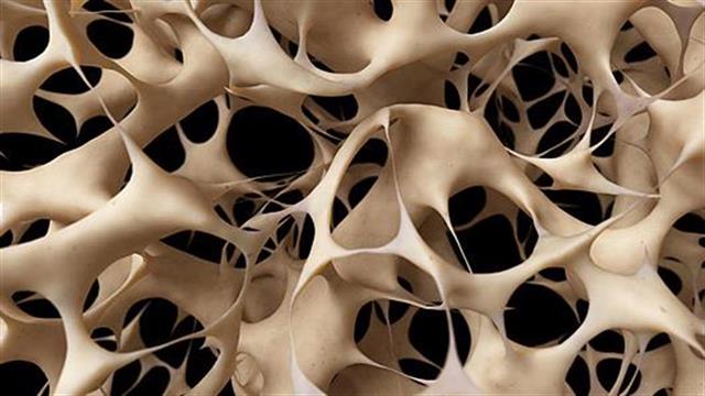 Μήπως κινδυνεύετε από οστεοπόρωση;