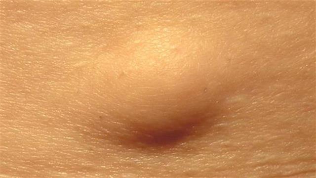 Γιατί είναι απαραίτητη η χειρουργική αφαίρεση των λιπωμάτων;