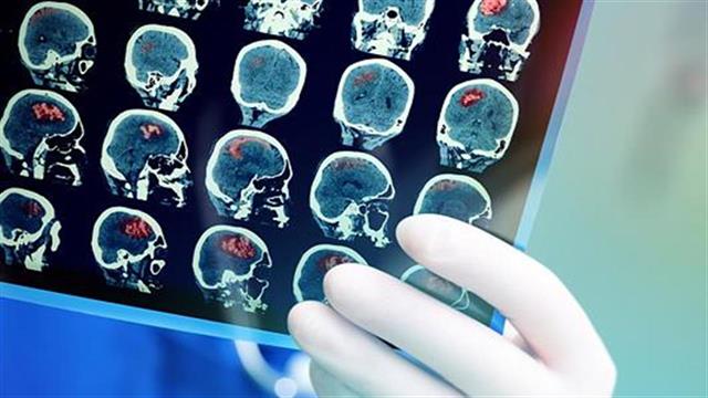 Εγκεφαλικό επεισόδιο: Παράγοντες κινδύνου και πρόληψη