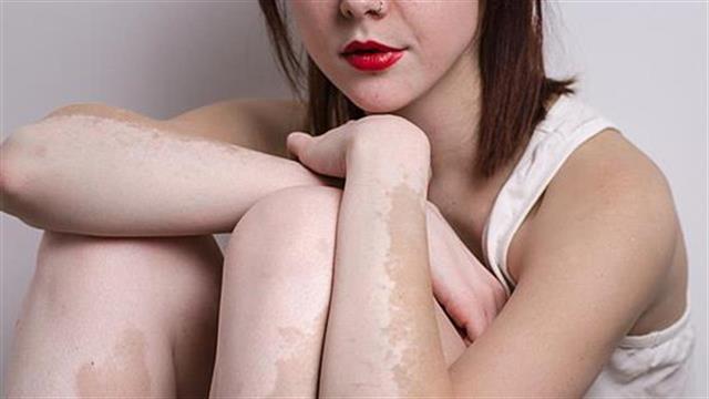 Εντοπίστηκαν περισσότερα γονίδια που συνδέονται με τη λεύκη