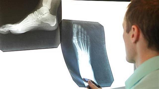 Η εμμηνόπαυση πριν τα 40 αυξάνει τον κίνδυνο καταγμάτων