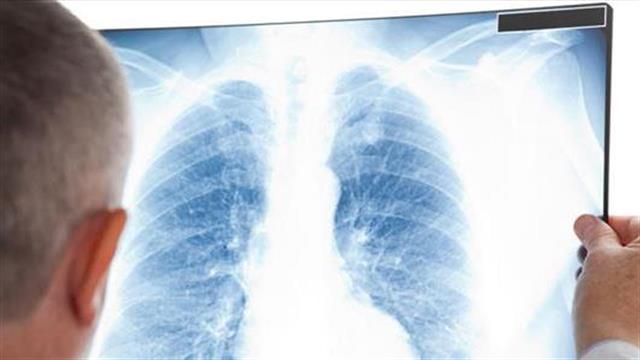FDA: Έγκριση στο atezolizumab για την αντιμετώπιση του μεταστατικού μη μικροκυτταρικού καρκίνου του πνεύμονα