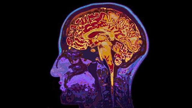 Εγκεφαλικό επεισόδιο: Χτυπά χωρίς προειδοποίηση