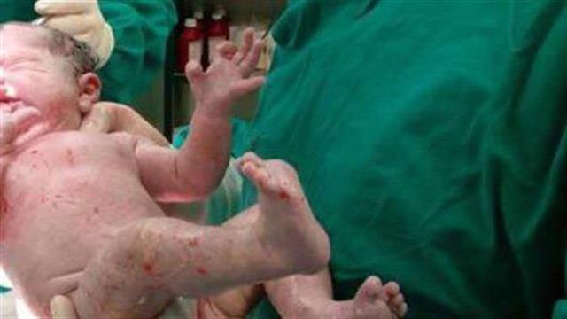 Την ανάγκη επανεξέτασης  της μεθόδου της καισαρικής τομής τόνισε ο πρόεδρος του ΙΣΑ