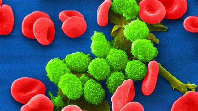 Πράσινο φως σε θεραπεία για τη Χρόνια Λεμφοκυτταρική Λευχαιμία από την ΕΕ