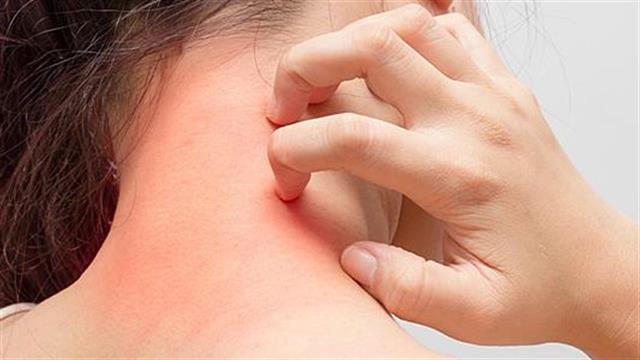 Συμβουλές για να ανακουφιστούμε από την φαγούρα της ψωρίασης