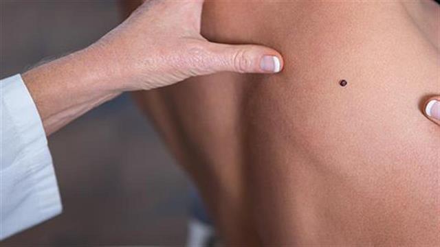 Καρκίνος του δέρματος: Παράγοντες κινδύνου που δεν είχαμε υπολογίσει