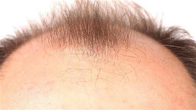 Φάρμακα για τον προστάτη και τη φαλάκρα δεν συνδέονται με κίνδυνο αυτοκτονίας