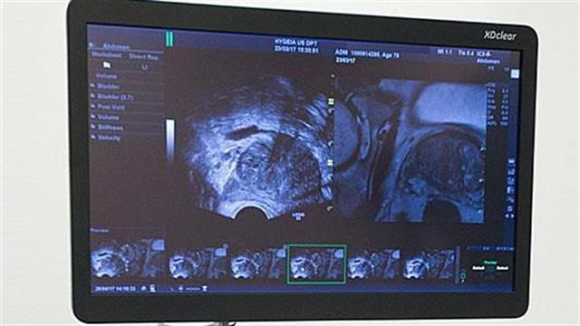 ΥΓΕΙΑ: Πρωτοποριακό Σύστημα Υβριδικής Απεικόνισης για τον καρκίνο του προστάτη