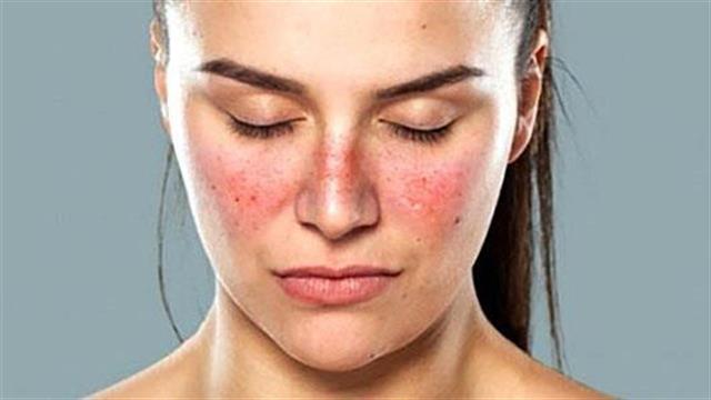 10η Μαΐου: Παγκόσμια Ημέρα κατά του Συστηματικού Ερυθηματώδη Λύκου