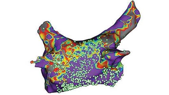 Νέο σύστημα καινοτόμου τεχνολογίας καρδιακής χαρτογράφησης στο Ωνάσειο