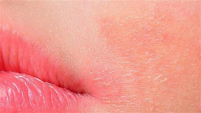 Ατοπική δερματίτιδα: Τι την επιδεινώνει;