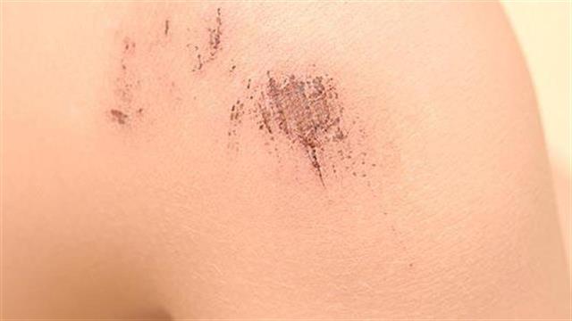 Εκδορές και κοψίματα: Αιτίες και αντιμετώπιση