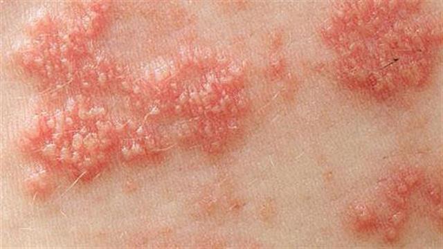 Έρευνα συνδέει τον έρπητα ζωστήρα με αυξημένο κίνδυνο εμφράγματος και εγκεφαλικού επεισοδίου