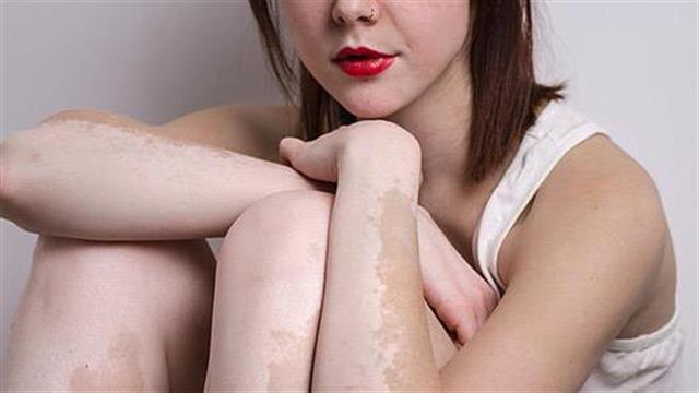 Καλοκαίρι και λεύκη: Χρήσιμες συμβουλές