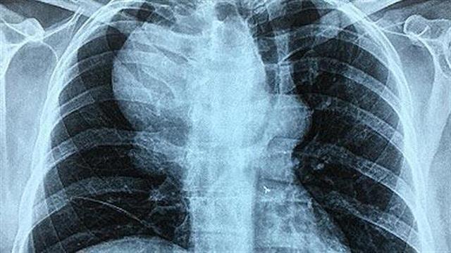 Αντιμετώπιση του μεγαλύτερου παγκοσμίως ανευρύσματος υποκλείδιας αρτηρίας στο Διαβαλκανικό