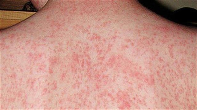 Υπαρκτός  κίνδυνος  έξαρσης ιλαράς στη χώρα μας