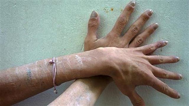 Ρευματισμοί: Δεν υπάρχει κίνδυνος καρκίνου από τους αναστολείς TNF-A