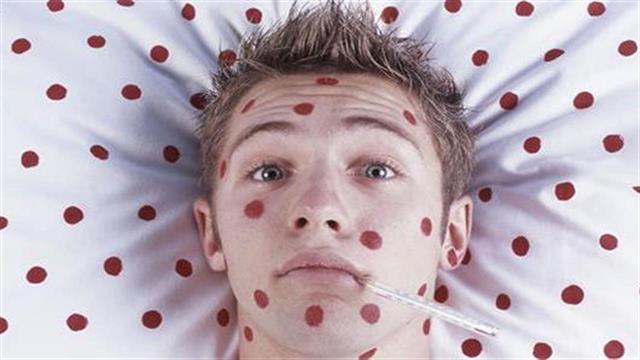 Ιλαρά: Οδηγίες της Ελληνικής Παιδιατρικής Εταιρείας – Ενημερωθείτε υπεύθυνα