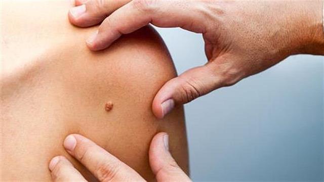 FDA: Σημαντική καινοτόμα θεραπεία το Cemiplimab