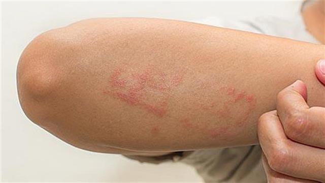 Έγκριση του Dupilumab για τη μέτρια έως σοβαρή ατοπική δερματίτιδα, στην Ε.Ε