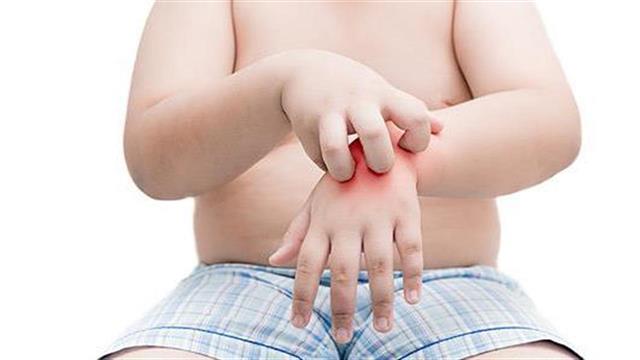 Τροφικές αλλεργίες στα παιδιά: Ποια είναι τα σημάδια;