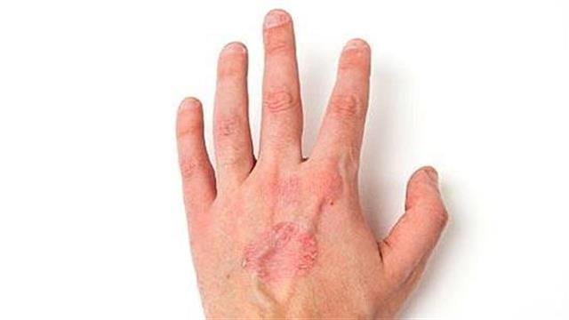 Ψωριασική Αρθρίτιδα: Mία νόσος με πολλά πρόσωπα