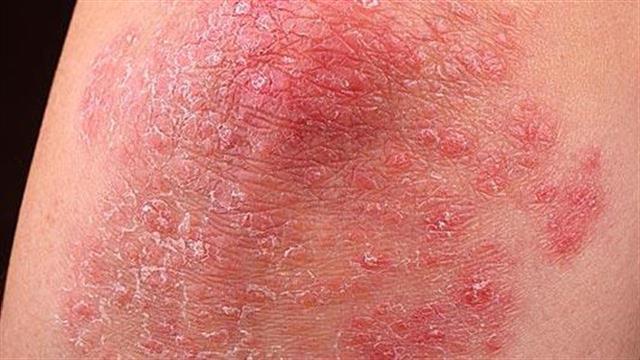 Όσα δεν γνωρίζατε για την ψωρίαση