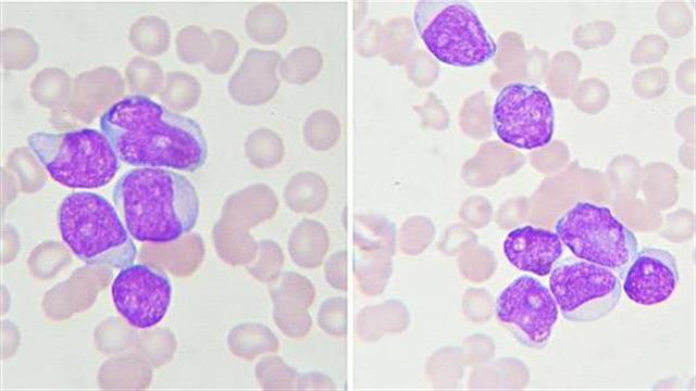 Εντοπίστηκε ένζυμο που συνδέεται με φτωχά ποσοστά επιβίωσης στη χρόνια μυελογενή λευχαιμία