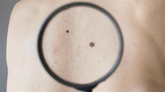 Επιστήμονες δοκιμάζουν εξέταση αίματος για το μελάνωμα και το λέμφωμα