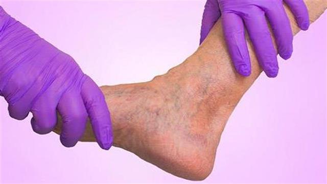 Μάστιγα για τις σύγχρονες κοινωνίες το διαβητικό πόδι