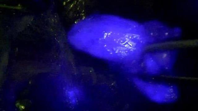 Νέα χειρουργική μέθοδος αντιμετώπισης καρκίνου του ενδομητρίου