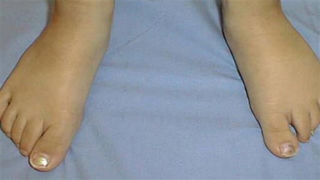 Ημέρα Ενημέρωσης για το Λεμφοίδημα η 6η Μαρτίου