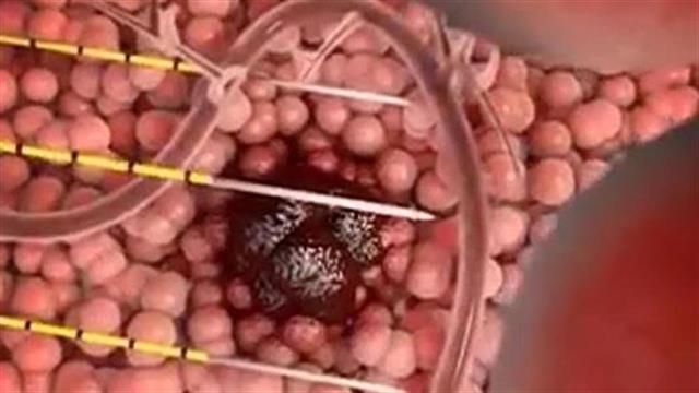 Καρκίνος του προστάτη: Η θεραπεία που έρχεται από το μέλλον