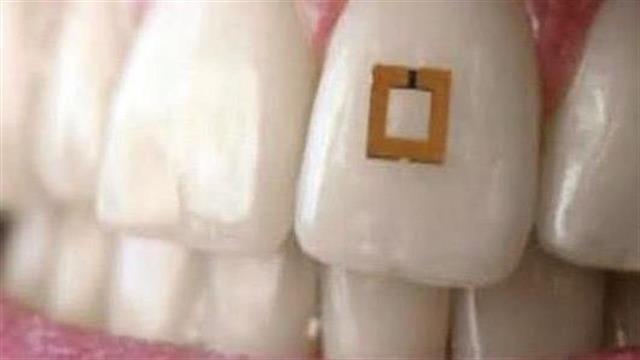 Chip στο δόντι αποκαλύπτει τι τρώτε