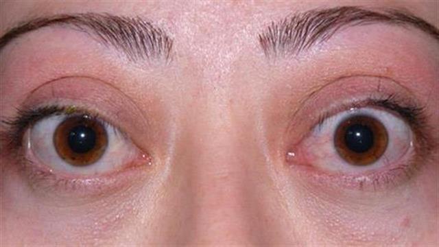 Υπερθυρεοειδισμός και νόσος του Graves: Όσα πρέπει να γνωρίζετε