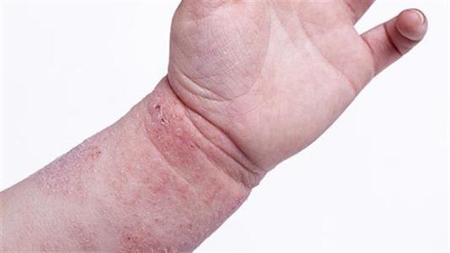 Ασθμα, έκζεμα, αλλεργική ρινίτιδα και κίνδυνος ψυχικών διαταραχών