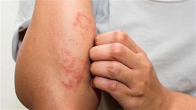 Μύθοι για το έκζεμα που πρέπει να ξεχάσουμε