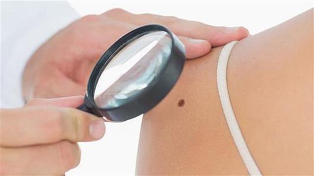 Εβδομάδα πρόληψης μελανώματος