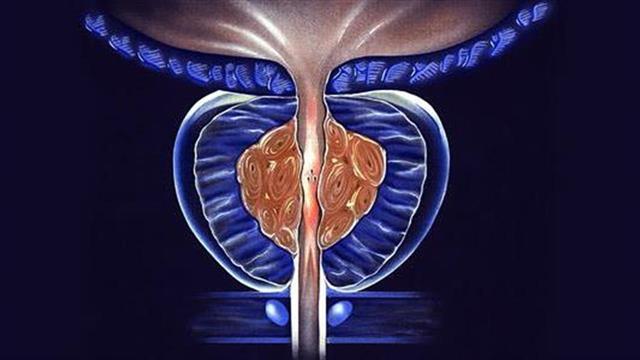 YΓΕΙΑ: Νέα επαναστατική απεικονιστική μέθοδος για την υποτροπή του καρκίνου του προστάτη
