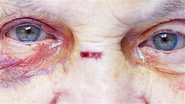 Το 15,7% των ανθρώπων τρίτης ηλικίας έχει πέσει θύμα κακοποίησης