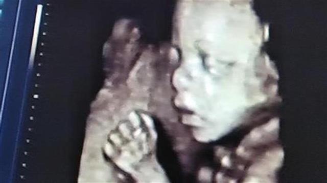 Τετραδιάστατη απεικόνιση του εμβρύου στη μήτρα