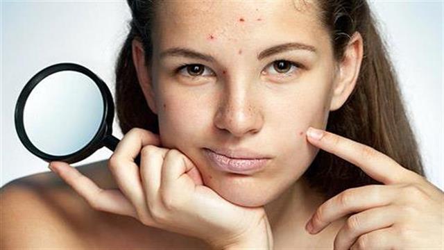 Ακμή: ποιες τροφές την επιδεινώνουν