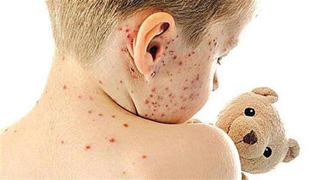 Καμπάνια του ΚΕΕΛΠΝΟ για την ιλαρά