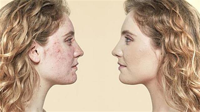Συμβουλές για επιδερμίδα με ροδόχρους ακμή. Πως να καλύψετε την ερυθρότητα