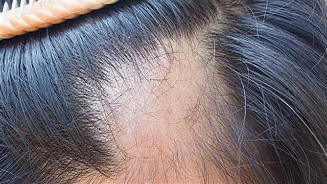 Τροφές για να αποφύγετε την τριχόπτωση